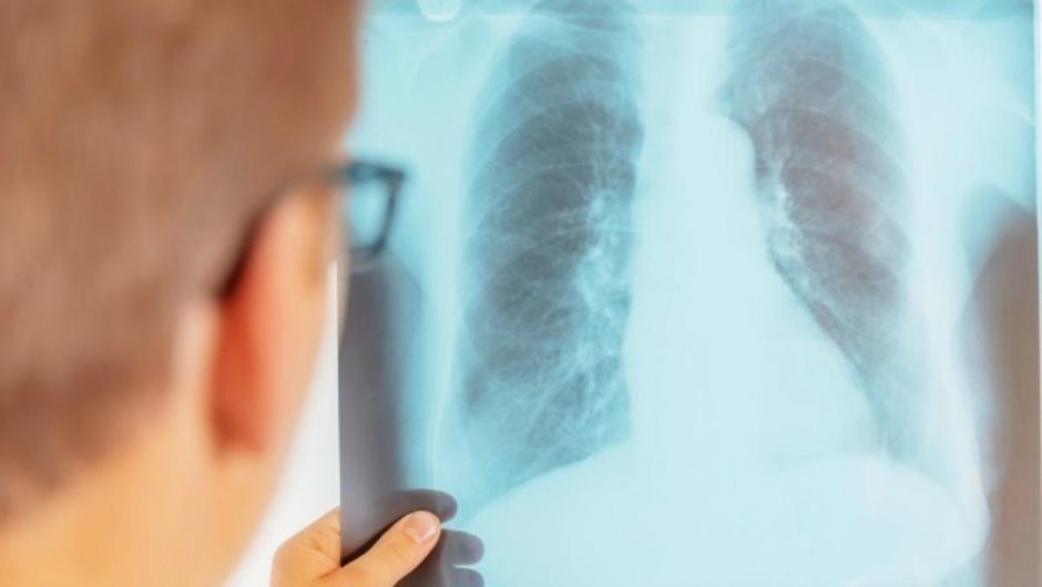Nauji vaistai ir tyrimai teikia vilties įveikti tuberkuliozę