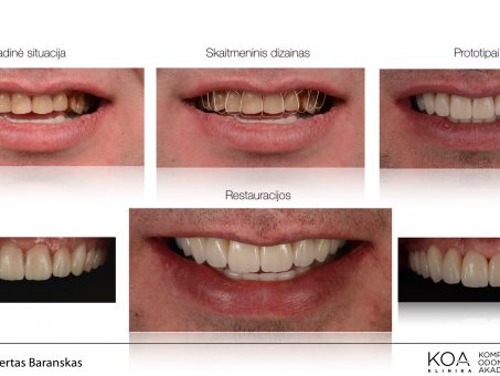 Skelbimas - Dantų protezavimas su CEREC technologija vos per vieną vizitą!