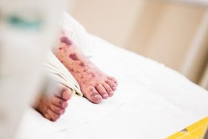 Gegužę Lietuvoje nuo meningokokinės infekcijos mirė nepilnametis