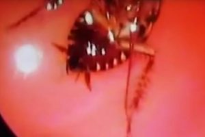 Iš indės nosies ištrauktas gyvas tarakonas
