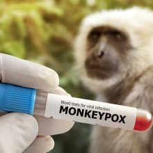 PSO: pasaulyje registruota per 50 tūkst. beždžionių raupų atvejų