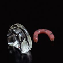 Skaitmeninė implantacija – dantų implantacijos metodas, užtikrinantis sėkmę ir ilgaamžiškumą