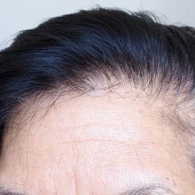 Moteriškoji androgeninės alopecijos pusė – iššūkiai ir lūkesčiai