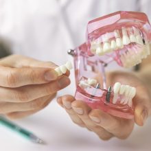 Kodėl dantų implantai laimi prieš vadinamuosius tiltus? 