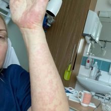 Koronavirusu persirgusiai Rūtai vėliau teko gultis į ligoninę: mano imunitetas pakvaišo