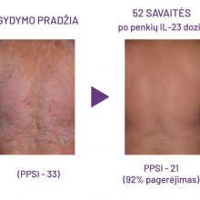 Klaipėdos universitetinėje ligoninėje – efektyvus psoriazės gydymas