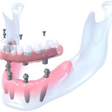 Dantų atkūrimas su 4 implantais.