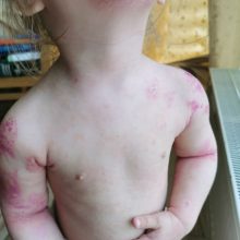 Stipriai išbertos mažametės mama: alergiją sukėlė skiepai