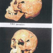 Nužmogėjusieji: kaukolės sužalojimai liudija, kad J.Semaška buvo nužudytas kirviu – šautinių žaizdų nei kūne, nei galvoje nerasta.