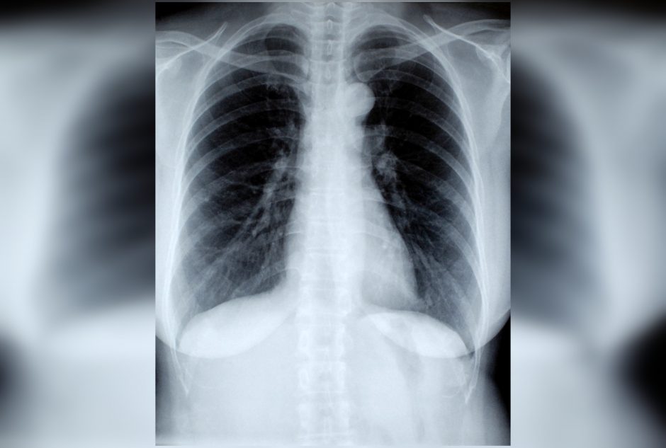 COVID-19 grimasos: daugėja užleistų plaučių ligų atvejų