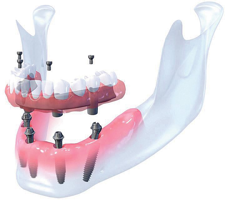 Dantų implantacija Garliavoje. Kuo stebina nauja klinika?