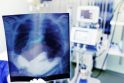 Diagnostika: įtarus tuberkuliozę atliekama krūtinės ląstos rentgenograma, bet šis metodas nėra pakankamai informatyvus.