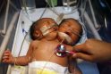 Filipinuose gimė kūdikis su dviem galvomis