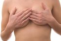 Kiaulės odos implantai vėžio aukoms padeda išlaikyti krūtinę