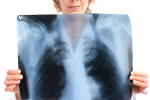 Medikai: kada paskutinį kartą Jums buvo atlikta krūtinės ląstos rentgenograma?